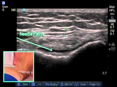 Ultrasound Guided Injections