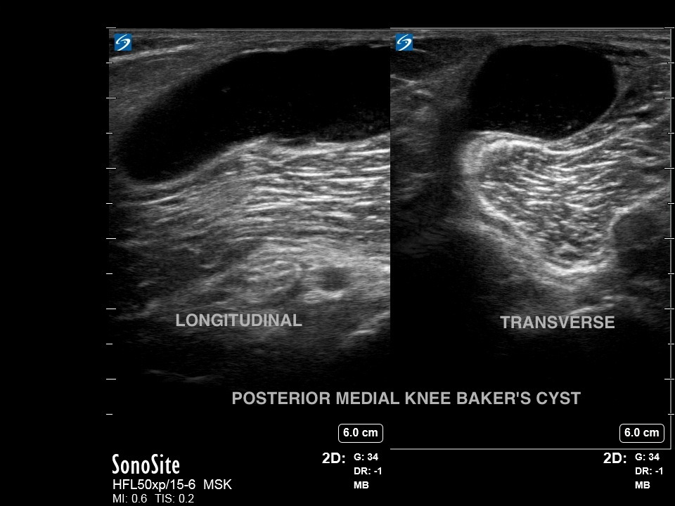 Knee Bakers Cyst Dual Image Knee Bakers Cyst Dual Image