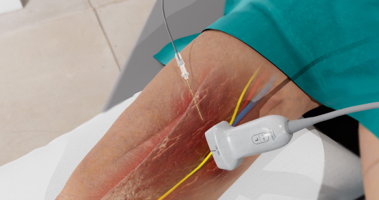 Infographic of Adductor canal block