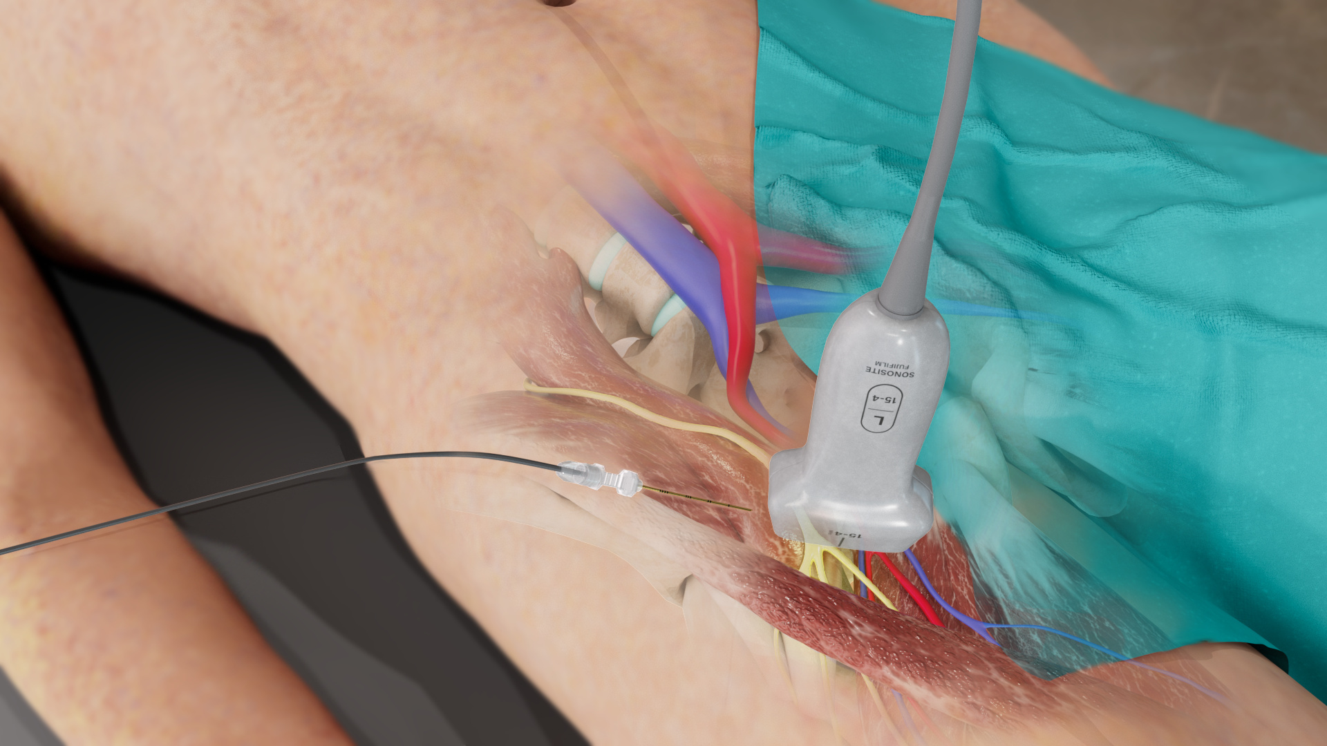 Image of femoral block