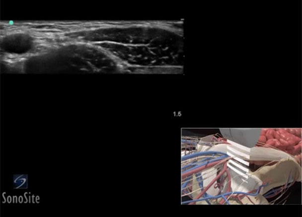3d how to: femoral nerve block | sonosite 3d how to: femoral nerve block | sonosite, Muscles