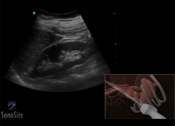 3d how to left kidney ultrasound sonosite