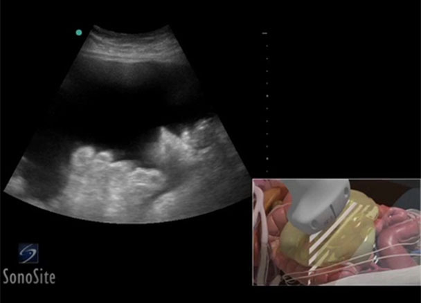 paracentesis