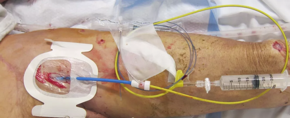 REBOA image on the Sonosite blog