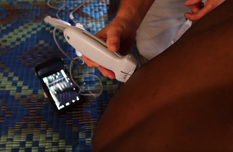 Sonosite Global Health: iViz in The Gambia