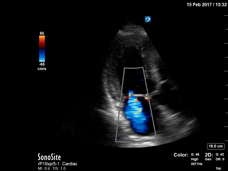 XP rP19 - Cardiac Apical 2 Chamber with Color - Mitral Regurgitation ...