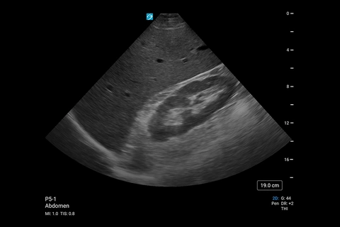 PX_P5-1 QSD abdominal