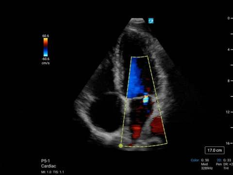 P5-1, chambre apicale cardiaque 4