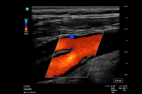 SONOSITE_PX_L12-3_Artérielle_Carotide_Plaque_CVD