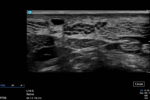 Sonosite_PX_L19-5_MSK_nerveau_médian_bifurqué