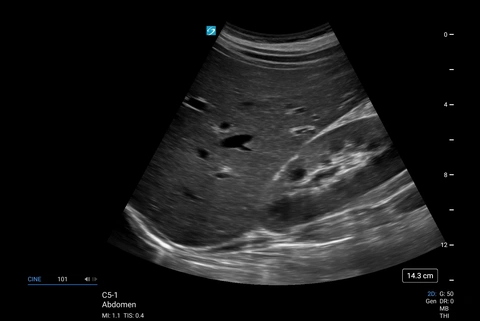 C5-1, QSD abdominal