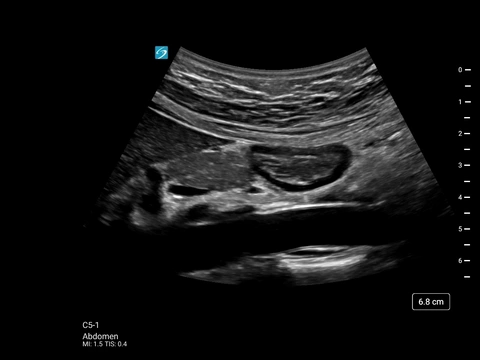 C5-1, Abdomen Gastric Antrum Long