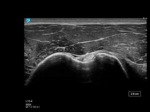 L15-4, MSK Biceps Tendon