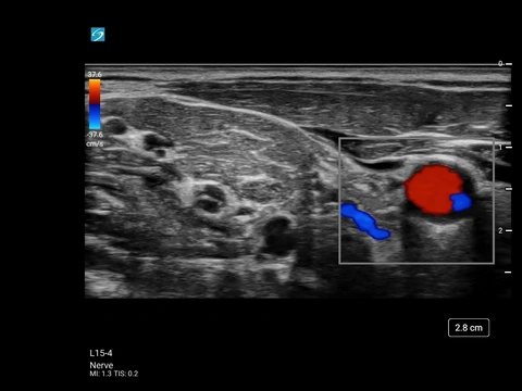 L15-4, Nerve Interscalene
