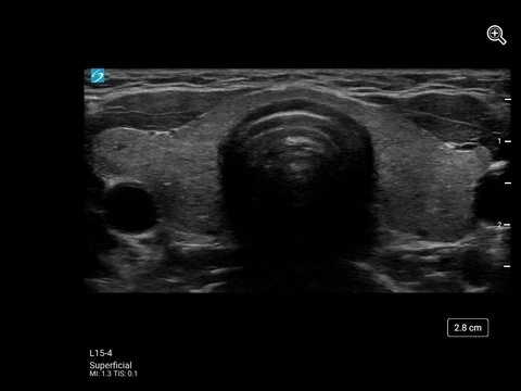L15-4, Thyroid
