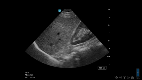 ZX - P5-1 - Abdomen - Right Upper Quadrant