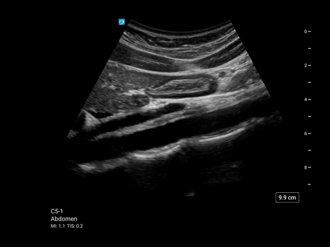 MT C5-1 Abdomen/Mageninhalt