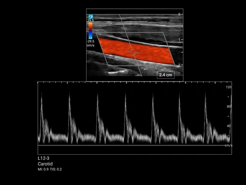 MT L12-3 Arteria Carotis PW Doppler 
