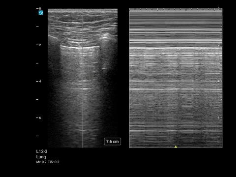 MT L12-3 Lungen M-Mode