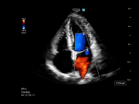 MT P5-1 Apikal 4 Kammer mit Farbdoppler
