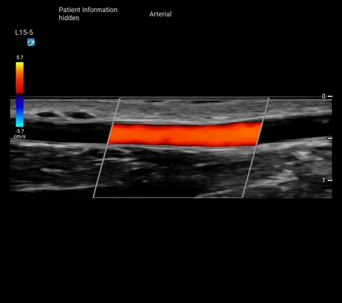 L15-5 Arterial Radial A Long