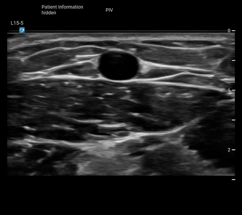 L15-5 PIV Cephalic V TRV