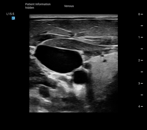 L15-5 Venous IJV Carotid Trv