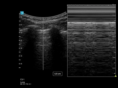 ST C5-1 Lung M-Mode