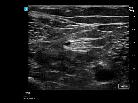 ST L12-3 Nerve Popliteal Sciatic