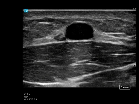 ST L19-5 PIV Forearm Vein