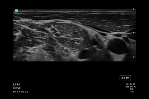 PX_L15-4 Nerve Interscalene PX_L15-4 Nerve Interscalene
