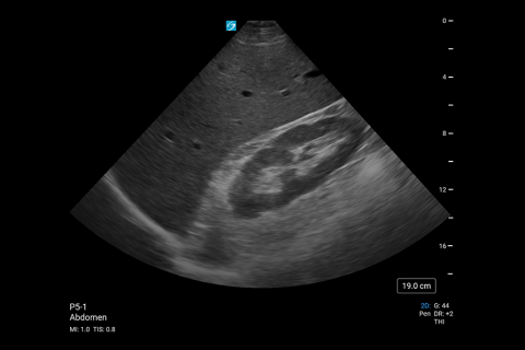 PX_P5-1 Abdominal RUQ PX_P5-1 Abdominal RUQ