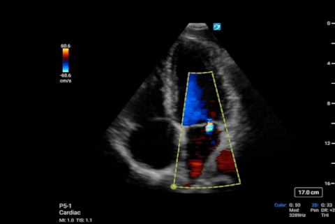 P5-1, Cardiac Apical 4 Chamber