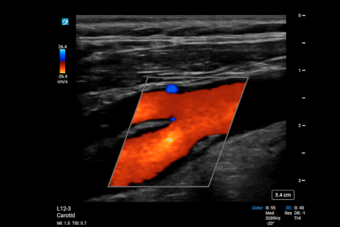 SONOSITE_PX_L12-3_Arterial_Carotid_Plaque_CVD SONOSITE_PX_L12-3_Arterial_Carotid_Plaque_CVD