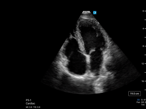 Sonosite_PX_P5_1_Crd_Apical Sonosite_PX_P5_1_Crd_Apical