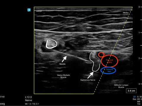 Clinical picture with labels of adductor canal block