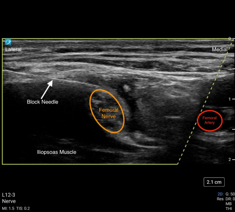 Clinical picture of femoral nerve block with labels