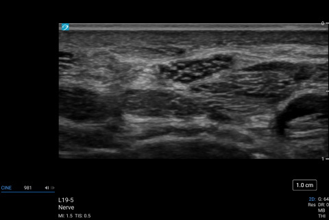 L19-5, Median Nerve
