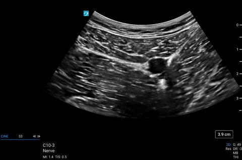 C10-3, Nerve Adductor Canal Block