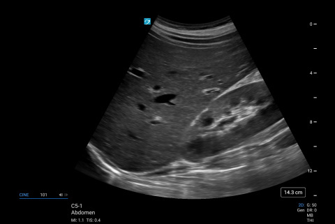 C5-1, Abdominal RUQ
