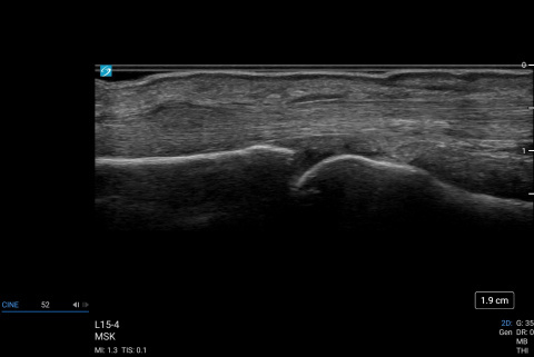 L15-4, MSK Finger A1 Pulley with Flexor Tendon