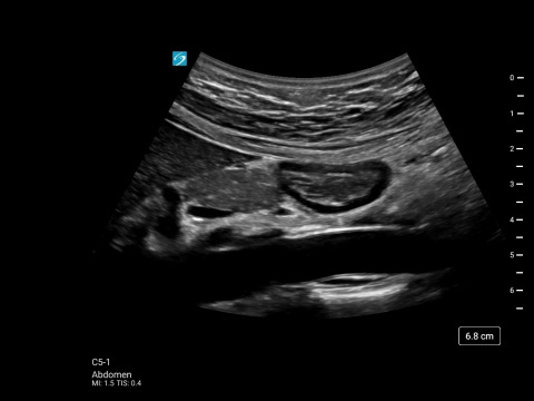 C5-1, Abdomen Gastric Antrum Long