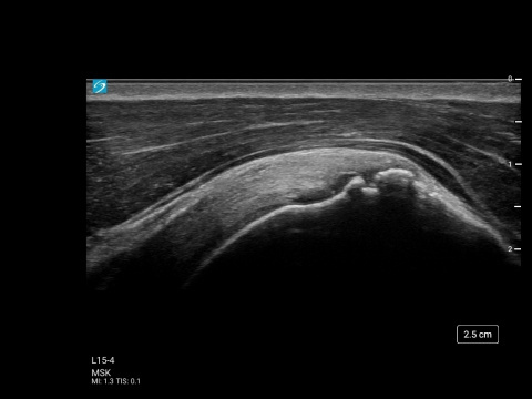 L15-4, MSK Supraspinatus Tendon