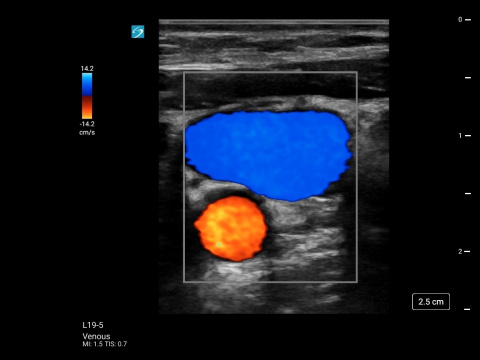 L19-5, Venous Internal Jugular Vein in Transverse