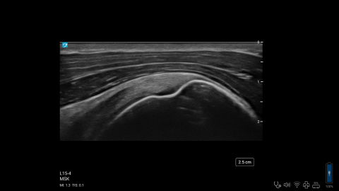 ZX - L15-4 - MSK - Surpraspinatus Tendon