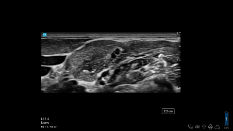 ZX - L15-4 - Nerve - Interscalene