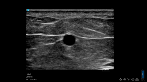 ZX - L19-5 - Venous - Basilic Vein or Forearm Vein