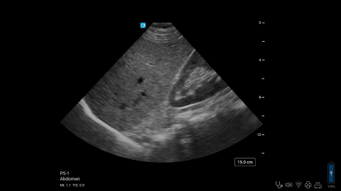 ZX - P5-1 - Abdomen - Right Upper Quadrant