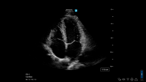 ZX - P5-1 - Cardiac - Apical 4 Chamber