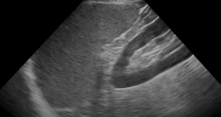Left Upper Quadrant (LUQ) – eFAST Left Upper Quadrant (LUQ) – eFAST